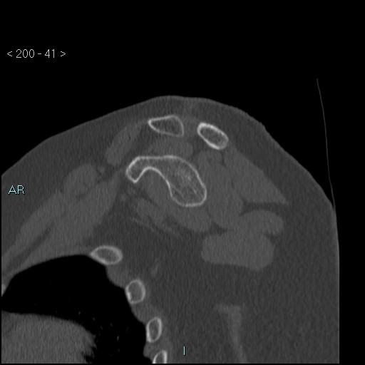 Avascular necrosis of the shoulder - Cruess stage I (Radiopaedia 77674-89887 Sagittal bone window 40).jpg