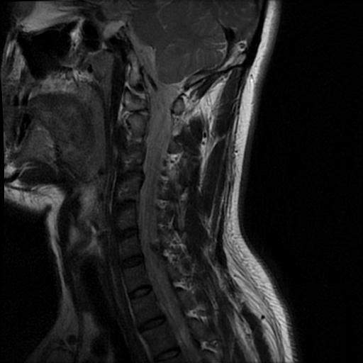 File:Axis fracture - MRI (Radiopaedia 71925-82375 Sagittal T2 3).jpg
