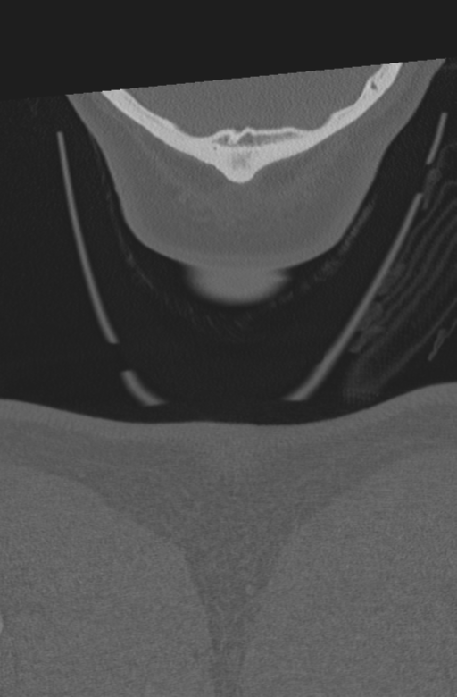 Axis peg fracture (type 3) and atlas lateral mass (type 4) fracture (Radiopaedia 37474-39324 Coronal bone window 80).png
