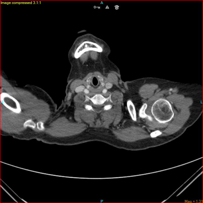 Azygos vein aneurysm (Radiopaedia 77824-90130 B 1).jpg
