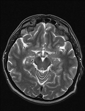 File:Balo concentric sclerosis (Radiopaedia 50458-55940 Axial T2 27).jpg