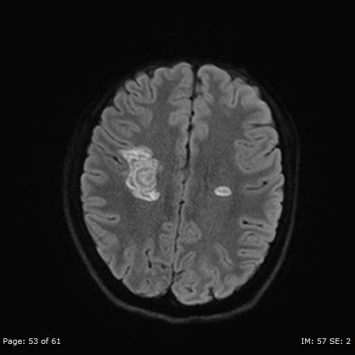 Balo concentric sclerosis (Radiopaedia 61637-69636 Axial DWI 53).jpg