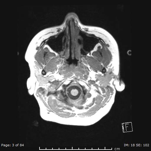 Balo concentric sclerosis (Radiopaedia 61637-69636 Axial T1 3).jpg