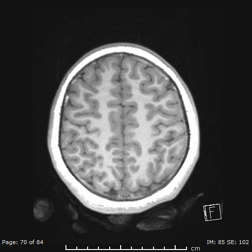 File:Balo concentric sclerosis (Radiopaedia 61637-69636 Axial T1 70).jpg