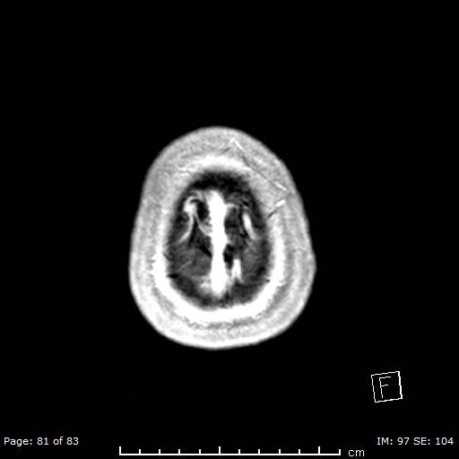 File:Balo concentric sclerosis (Radiopaedia 61637-69636 Axial T1 C+ 81).jpg
