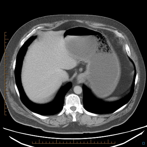 File:Bariatric balloon causing gastric outlet obstruction (Radiopaedia 54449-60672 A 8).jpg