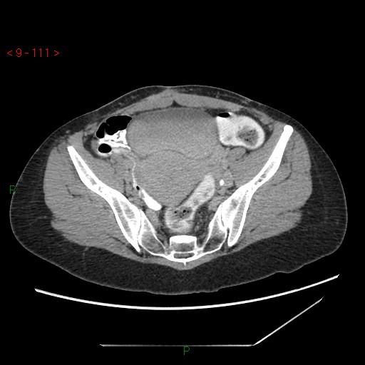 File:Bartholin gland cyst (Radiopaedia 54904-61181 Axial C+ delayed 28).jpg