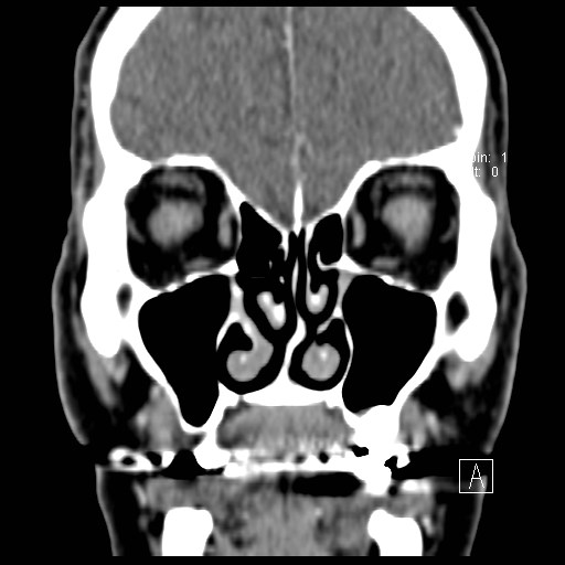 File:Basal cell carcinoma (periocular with orbital invasion) (Radiopaedia 30974-31672 Coronal Postcontrast 16).jpg