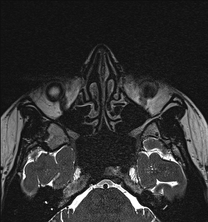 Basal cell carcinoma - nasal region (Radiopaedia 70292-80365 Axial Gradient Echo 52).jpg