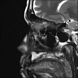 File:Basal cell carcinoma - nasal region (Radiopaedia 70292-80365 Sagittal T2 4).jpg