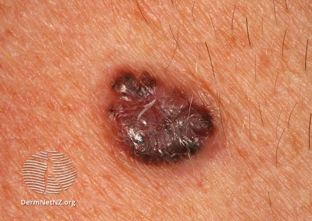 File:Basal cell carcinoma affecting the trunk (DermNet NZ lesions-bcc-trunk-0661).jpg