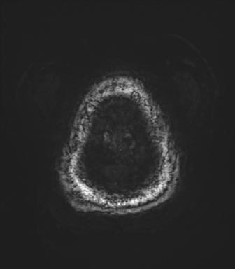 Basal ganglia hemorrhage - hypertensive (Radiopaedia 42227-45303 Axial SWI magnitude 87).png