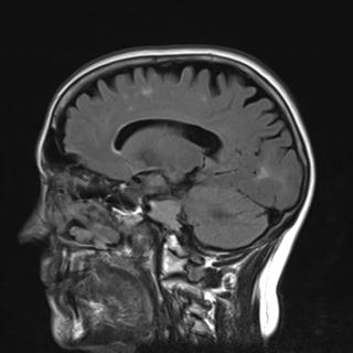 File:Base of skull chondrosarcoma (Radiopaedia 30410-31070 Sagittal FLAIR 8).jpg
