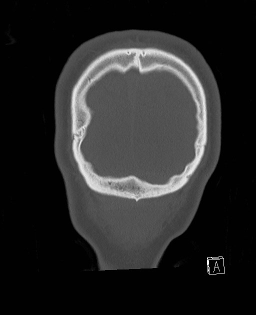 Base of skull fracture with bilateral Le Fort fractures (Radiopaedia 47094-51638 Coronal bone window 8).jpg
