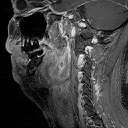 File:Base of tongue squamous cell carcinoma (Radiopaedia 31174-31884 F 61).jpg