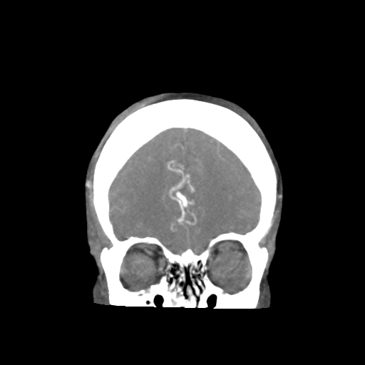 Basilar and bilateral vertebral artery occlusion (Radiopaedia 45592-49723 B 23).png