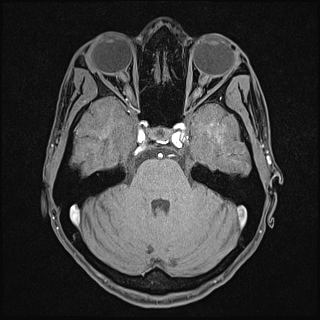Basilar artery perforator aneurysm (Radiopaedia 82455-97733 Axial T1 fat sat 47).jpg
