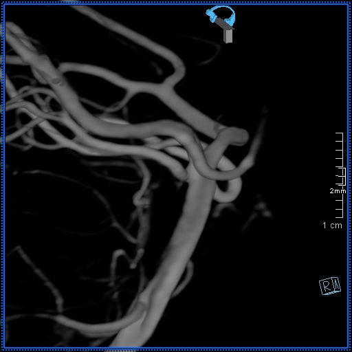 Basilar artery perforator aneurysm (Radiopaedia 82455-99524 3D Left VA 59).jpg