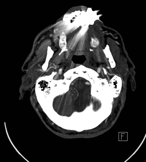 Basilar artery thrombosis (Radiopaedia 26986-27163 A 13).jpg