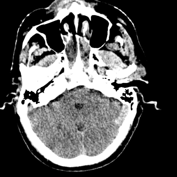 Basilar artery thrombosis (Radiopaedia 53351-59333 Axial non-contrast 39).jpg