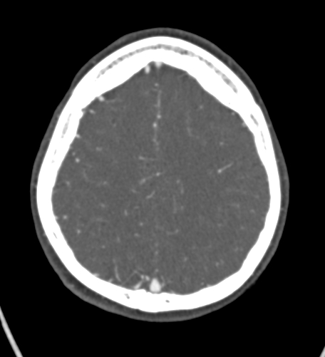 Basilar tip aneurysm with coiling (Radiopaedia 53912-60086 A 116).jpg