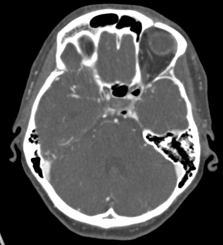 Basilar tip aneurysm with coiling (Radiopaedia 53912-60086 A 49).jpg