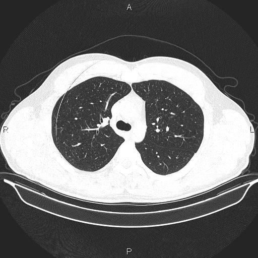 Beam hardening and ring artifacts (Radiopaedia 85323-100915 Axial lung window 28).jpg