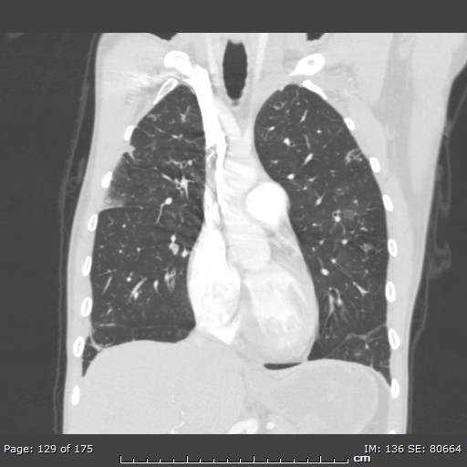 File:Behçet disease (Radiopaedia 44247-47889 Coronal lung window 40).jpg