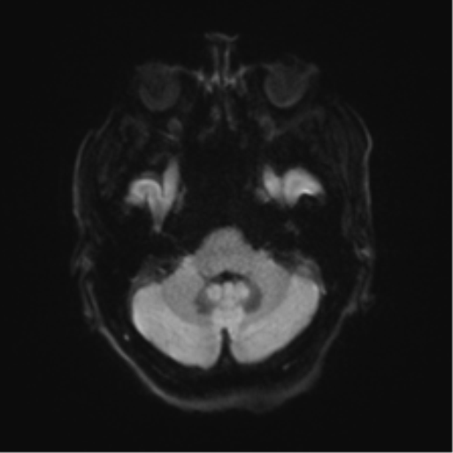 Behavioral variant frontotemporal dementia and late onset schizophrenia (Radiopaedia 52197-58083 Axial DTI Trace W 33).png