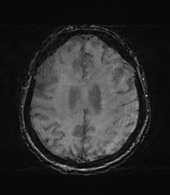 Behavioral variant frontotemporal dementia and late onset schizophrenia (Radiopaedia 52197-58083 Axial SWI 52).png
