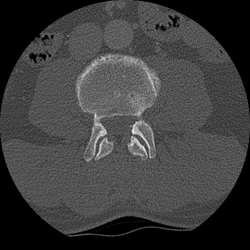 Benign post-traumatic pseudopneumoperitoneum (Radiopaedia 71199-81495 Axial bone window 232).jpg