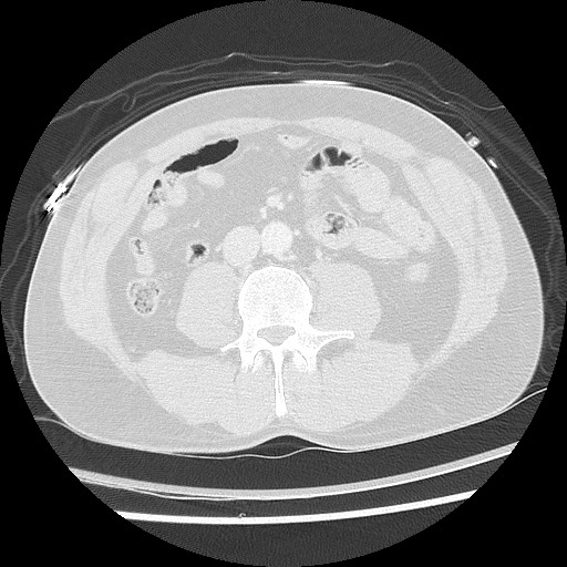 Benign post-traumatic pseudopneumoperitoneum (Radiopaedia 71199-81495 Axial lung window 95).jpg