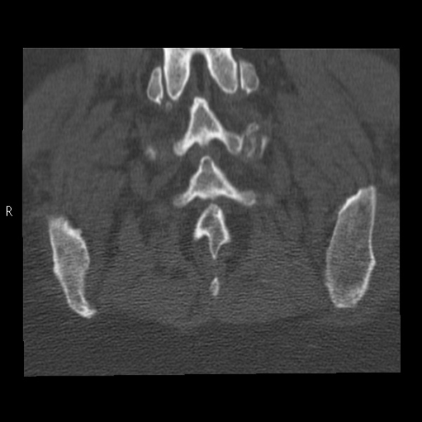 Bertolotti syndrome (Radiopaedia 24864-25128 Coronal bone window 42).jpg