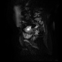 File:Bicornuate uterus (Radiopaedia 51676-57472 Sagittal DWI 10).jpg
