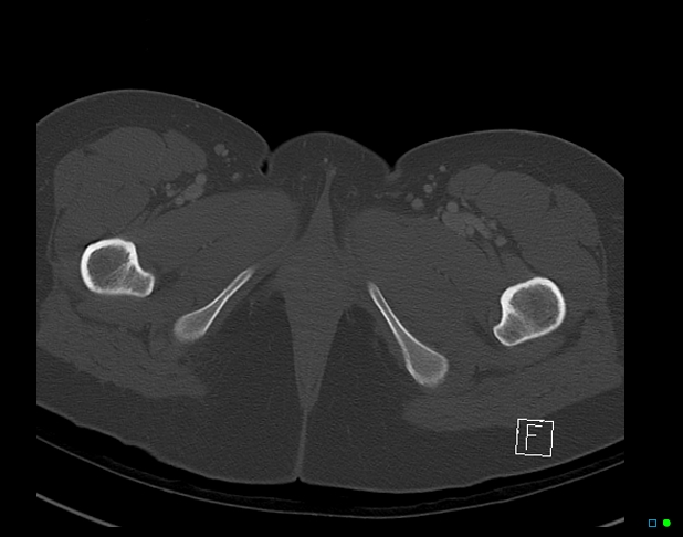 Bilateral acetabular fractures (Radiopaedia 79272-92308 Axial bone window 64).jpg