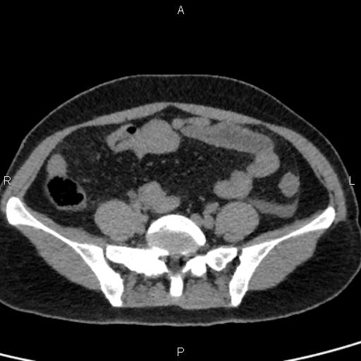Bilateral adrenal gland hyperenhancement in pancreatitis (Radiopaedia 86642-102753 Axial non-contrast 81).jpg