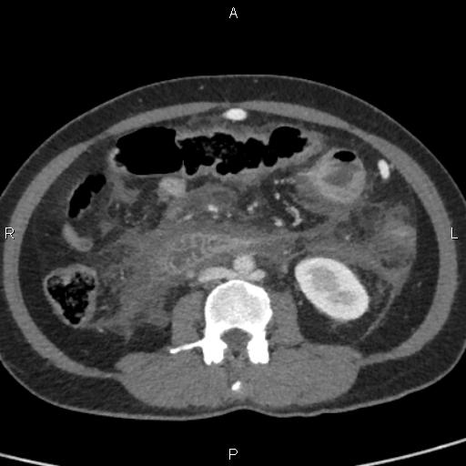 Bilateral adrenal gland hyperenhancement in pancreatitis (Radiopaedia 86642-102753 E 61).jpg