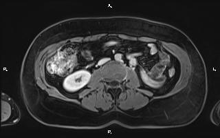 File:Bilateral adrenal myelolipoma (Radiopaedia 63058-71537 H 62).jpg