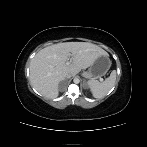 Bilateral adrenal thrombosis (Radiopaedia 58182-65256 A 15).jpg