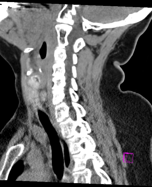 Bilateral atlanto-occipital assimilation (Radiopaedia 28350-28603 D 47).jpg