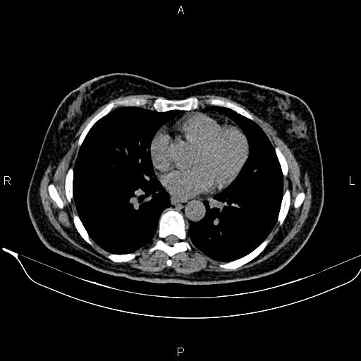 Bilateral benign adrenal adenomas (Radiopaedia 86912-103124 Axial non-contrast 5).jpg