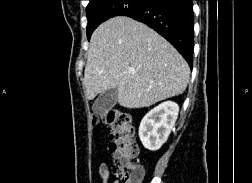 Bilateral benign adrenal adenomas (Radiopaedia 86912-103124 E 23).jpg