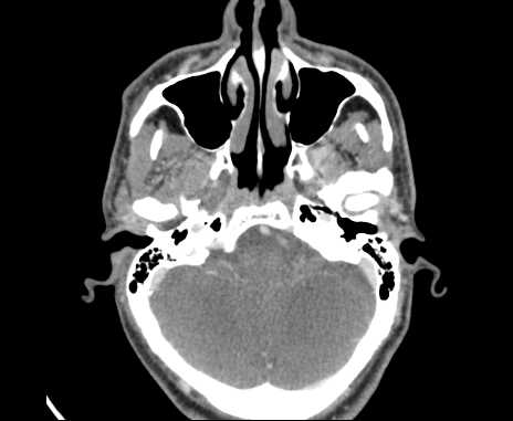 File:Bilateral carotid body tumors (Radiopaedia 61841-69870 Axial Post contrast 3).jpg