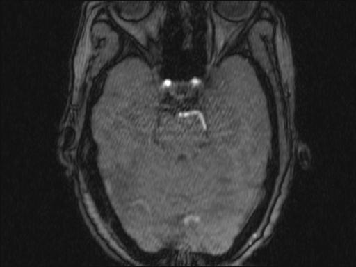 Bilateral carotid body tumors and right glomus jugulare tumor (Radiopaedia 20024-20060 Axial MRA 330).jpg