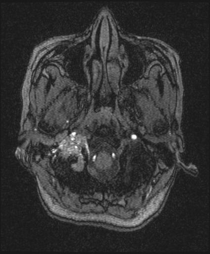 File:Bilateral carotid body tumors and right jugular paraganglioma (Radiopaedia 20024-20060 Axial 134).jpg
