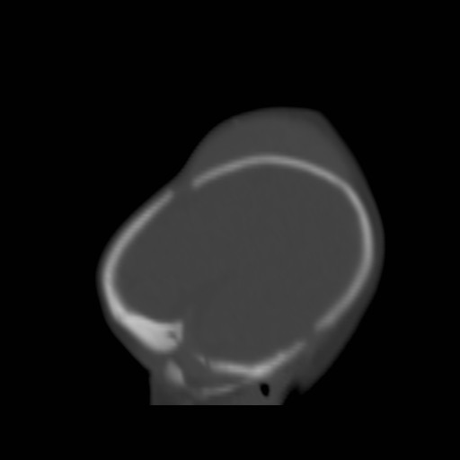 File:Bilateral cephalohematomas and subdural hematomas (Radiopaedia 26778-26929 Sagittal bone window 6).jpg