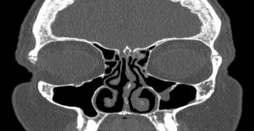 File:Bilateral ectopic infraorbital nerves (Radiopaedia 49006-54084 Coronal 47).png