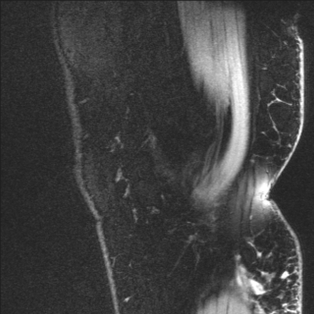 Bilateral focal pigmented villonodular synovitis (Radiopaedia 67643-77046 G 3).jpg
