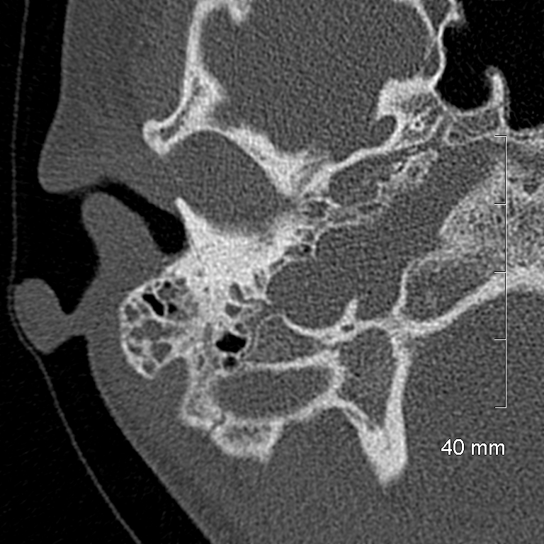 Bilateral grommets (Radiopaedia 47710-52404 Axial bone window 19).jpg