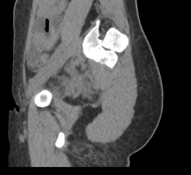 Bilateral mature cystic ovarian teratoma (Radiopaedia 88821-105592 D 56).jpg